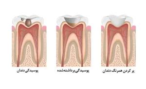 انواع پوسیدگی دندان