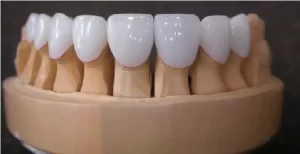 لمینت دندان