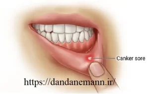 آفت دهان چیست؟