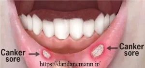 انواع آفت دهانی